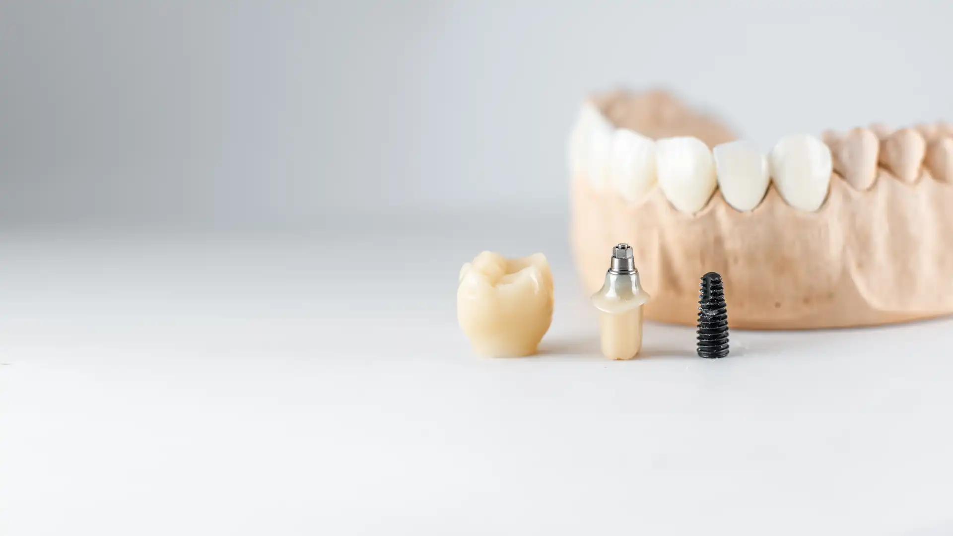 Dentaduras Postizas en Plantation, FL 1 Dentaduras postizas en Plantation, FL — Luxe & Kamel Dentistry