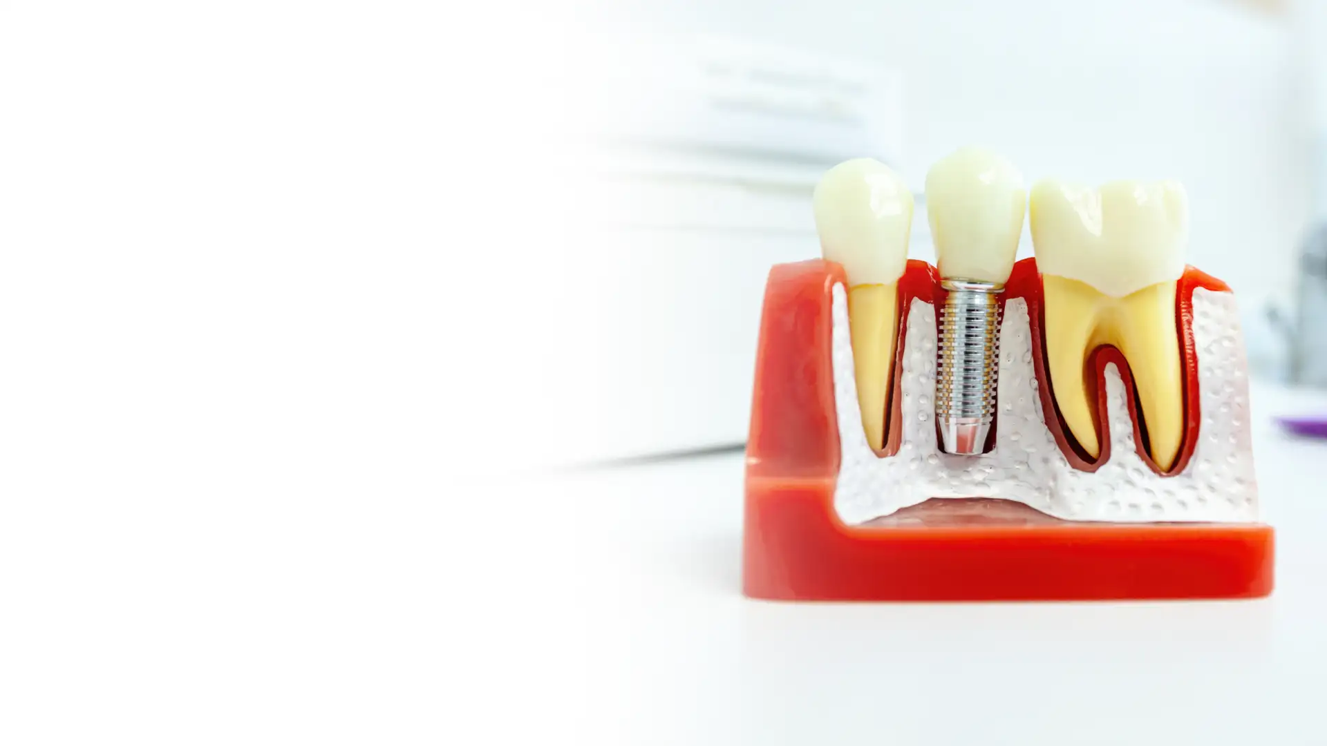 Dental implant model showing a titanium post and crown — dental implants in Plantation, FL