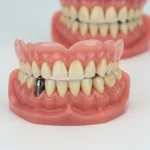 When Your Dentist May Recommend Implant Supported Dentures 5 When Your Dentist May Recommend Implant Supported Dentures